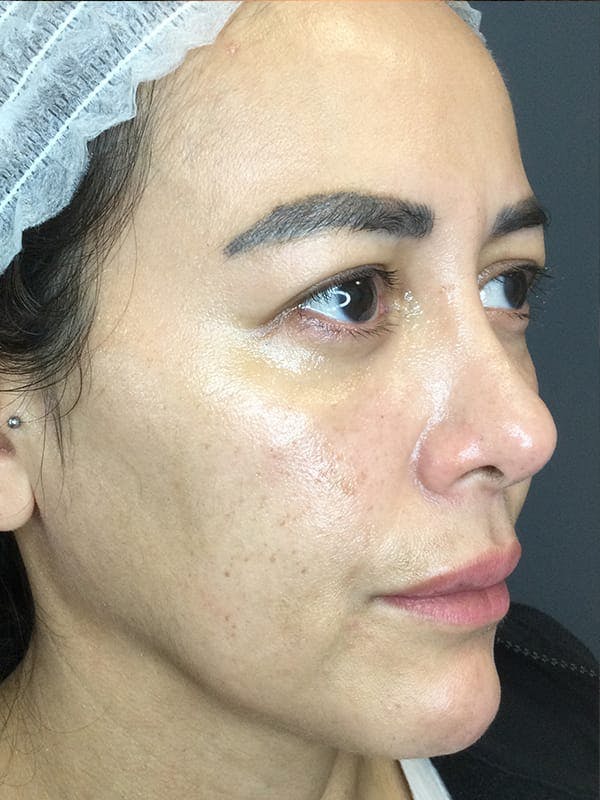 Fillers Before & After Gallery - Patient 307960 - Image 3