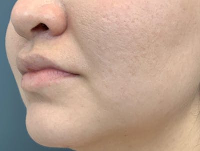 Kybella Before & After Gallery - Patient 209650 - Image 10