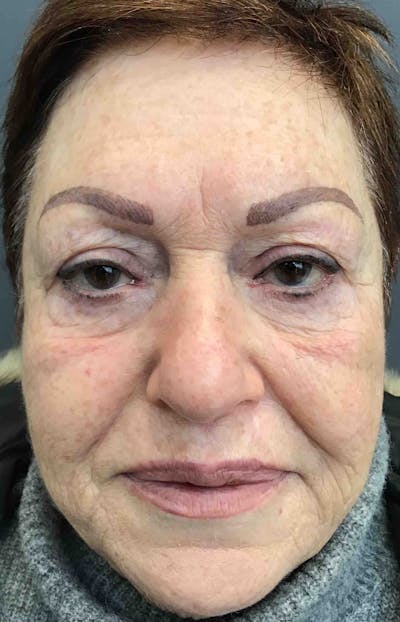 Sculptra Before & After Gallery - Patient 125622 - Image 1