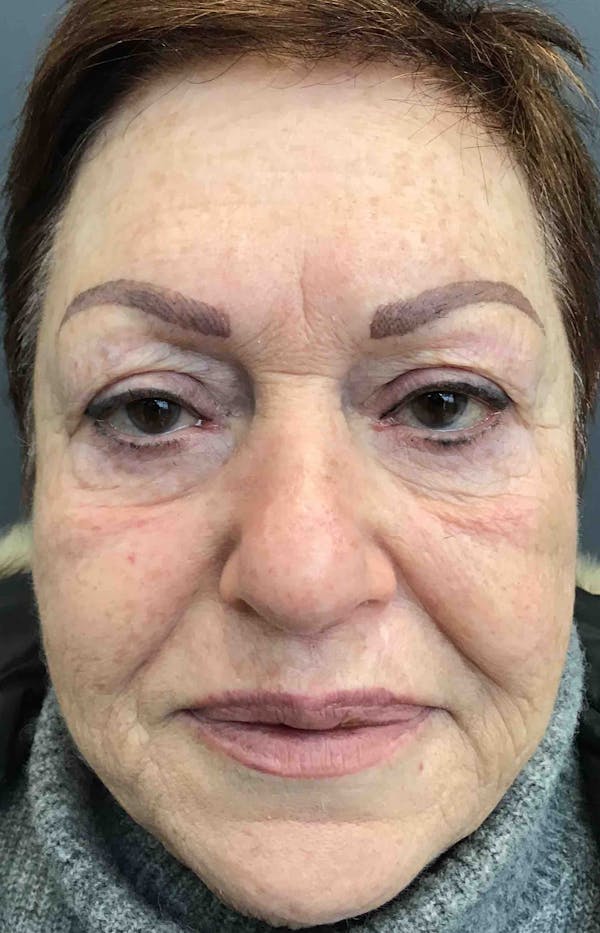 Sculptra Before & After Gallery - Patient 125622 - Image 1