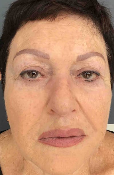 Sculptra Before & After Gallery - Patient 125622 - Image 2