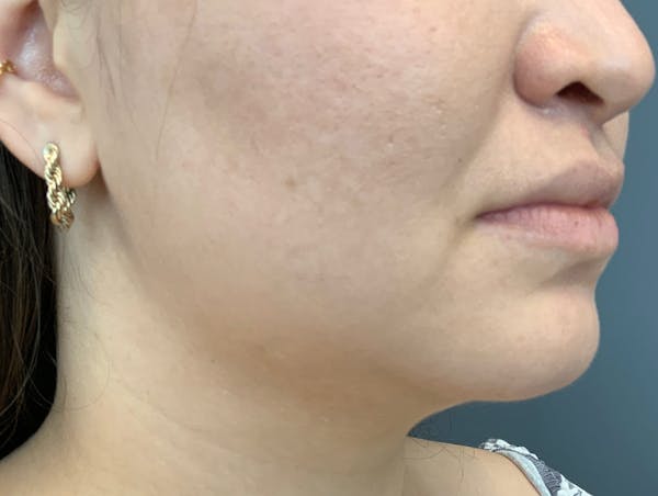 Kybella Before & After Gallery - Patient 209650 - Image 2