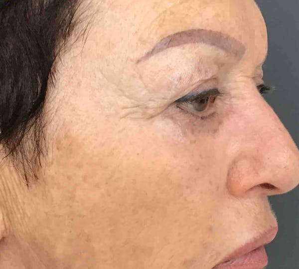 Sculptra Before & After Gallery - Patient 125622 - Image 6
