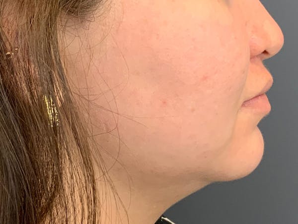 Kybella Before & After Gallery - Patient 209650 - Image 3