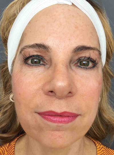 Sculptra Before & After Gallery - Patient 359212 - Image 1