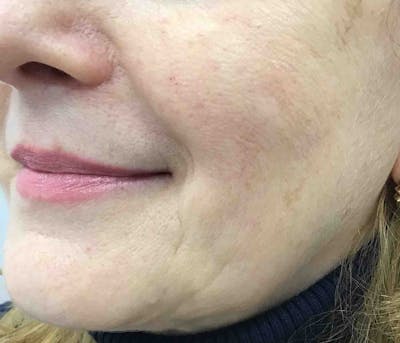 Sculptra Before & After Gallery - Patient 604335 - Image 2
