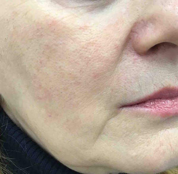 Sculptra Before & After Gallery - Patient 604335 - Image 3