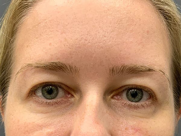 Botox Before & After Gallery - Patient 390648 - Image 2