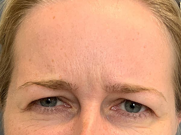 Botox Before & After Gallery - Patient 390648 - Image 3