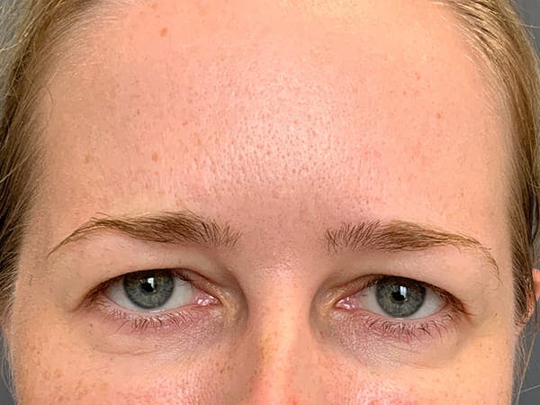 Botox Before & After Gallery - Patient 390648 - Image 4