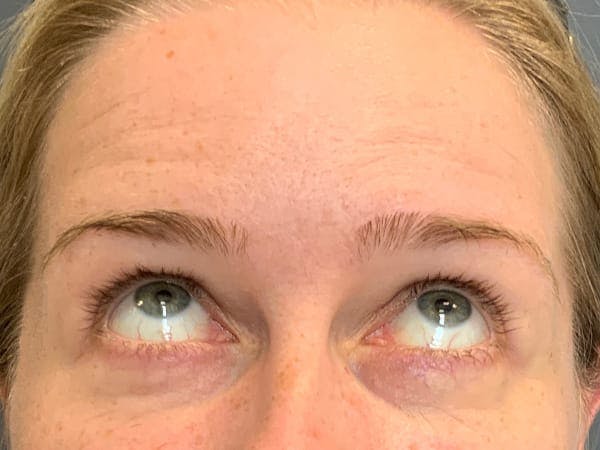 Botox Before & After Gallery - Patient 390648 - Image 5