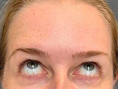 Botox Before & After Gallery - Patient 390648 - Image 6