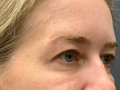 Botox Before & After Gallery - Patient 390648 - Image 8