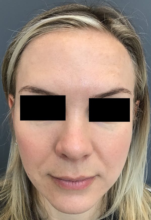 Botox Before & After Gallery - Patient 386509 - Image 2