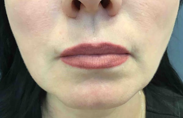 Botox Before & After Gallery - Patient 218774 - Image 2
