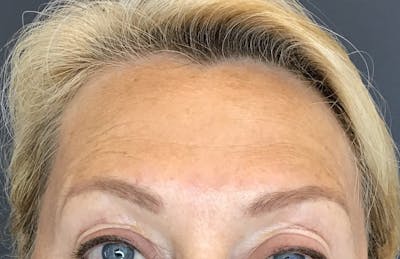 Botox Before & After Gallery - Patient 128842 - Image 2