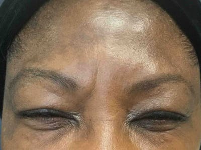 Botox Before & After Gallery - Patient 135513 - Image 2