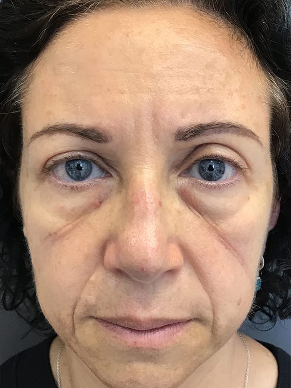 Fillers Before & After Gallery - Patient 161018 - Image 1