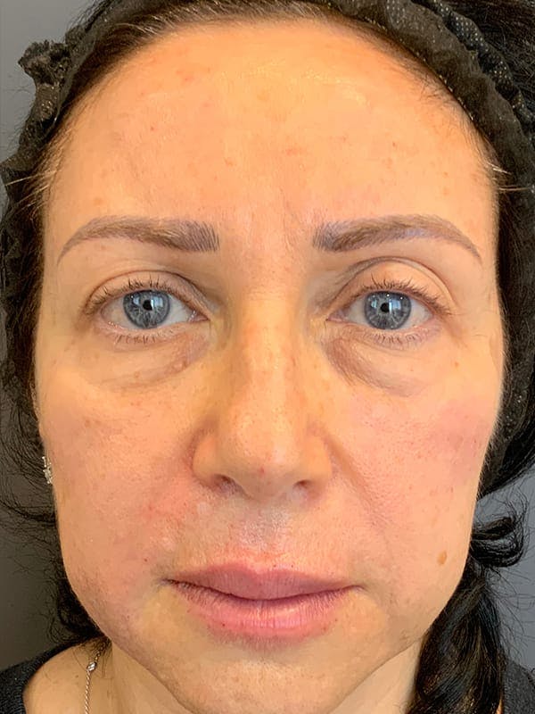 Fillers Before & After Gallery - Patient 161018 - Image 2