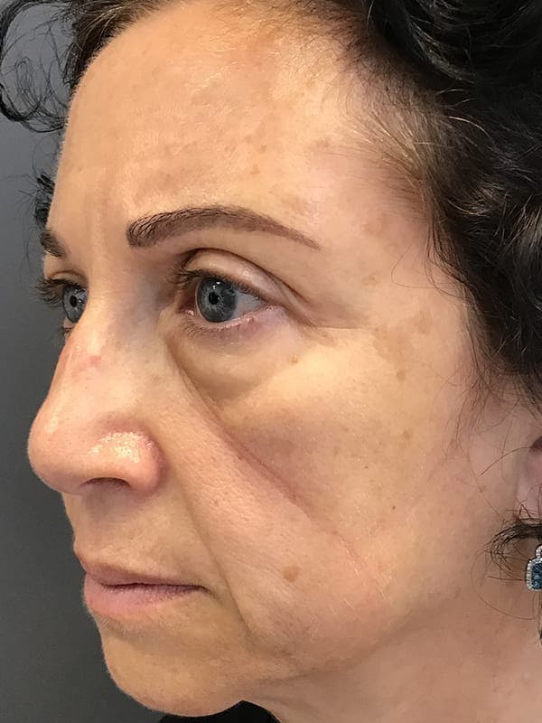 Fillers Before & After Gallery - Patient 161018 - Image 3