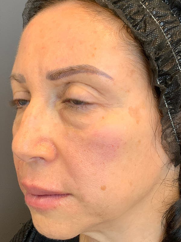 Fillers Before & After Gallery - Patient 161018 - Image 4