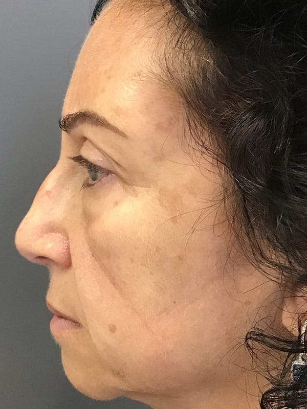 Fillers Before & After Gallery - Patient 161018 - Image 5