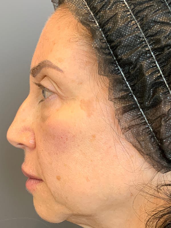 Fillers Before & After Gallery - Patient 161018 - Image 6