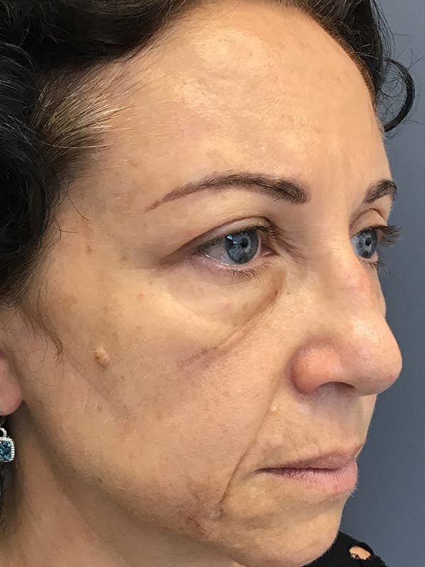 Fillers Before & After Gallery - Patient 161018 - Image 7