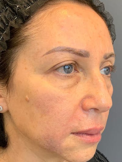 Fillers Before & After Gallery - Patient 161018 - Image 8