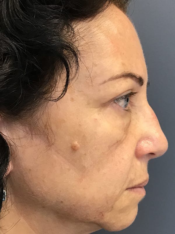 Fillers Before & After Gallery - Patient 161018 - Image 9