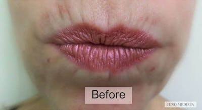 Botox Before & After Gallery - Patient 335432 - Image 1