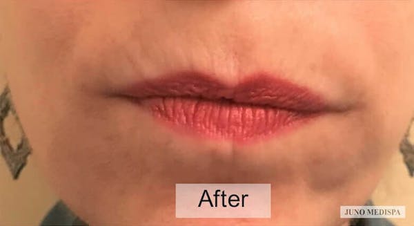 Botox Before & After Gallery - Patient 335432 - Image 2