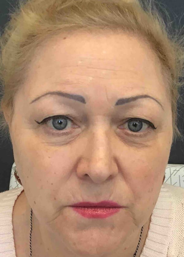 Fillers Before & After Gallery - Patient 386351 - Image 2