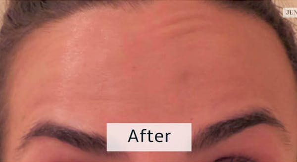 Botox Before & After Gallery - Patient 112822 - Image 2
