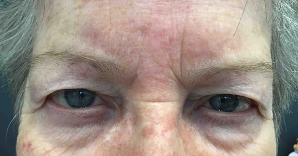 Botox Before & After Gallery - Patient 191148 - Image 1