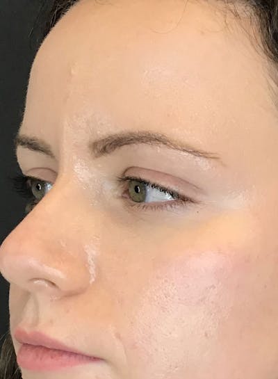 Fillers Before & After Gallery - Patient 416114 - Image 4