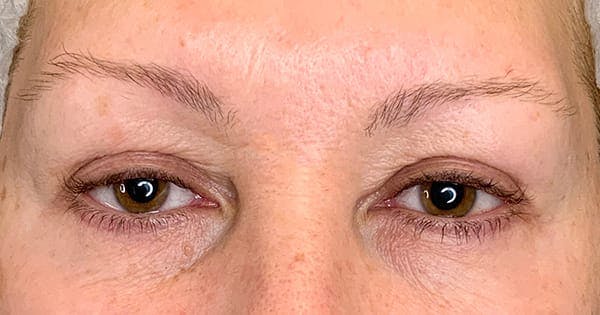 Botox Before & After Gallery - Patient 142000 - Image 2