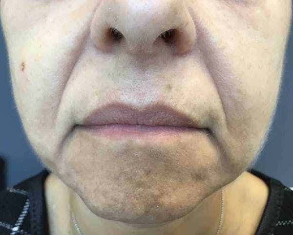 Fillers Before & After Gallery - Patient 978433 - Image 1