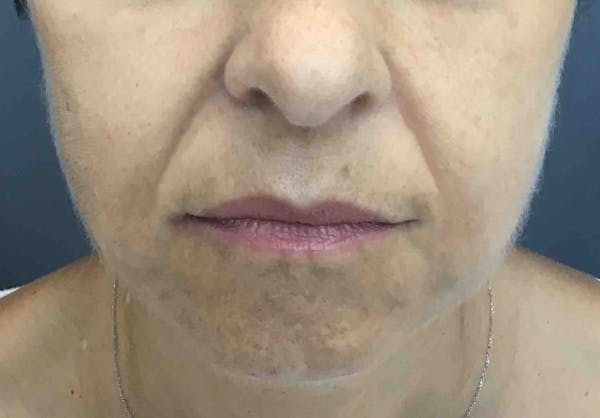 Fillers Before & After Gallery - Patient 978433 - Image 2