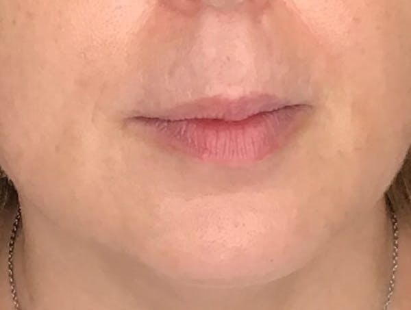Fillers Before & After Gallery - Patient 215029 - Image 1