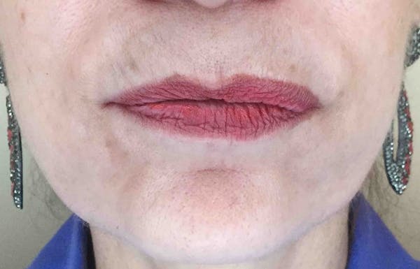 Fillers Before & After Gallery - Patient 139099 - Image 1
