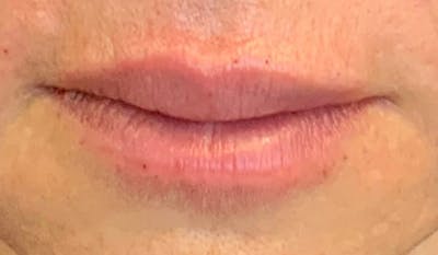 Fillers Before & After Gallery - Patient 122800 - Image 2