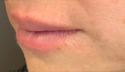 Fillers Before & After Gallery - Patient 122800 - Image 4