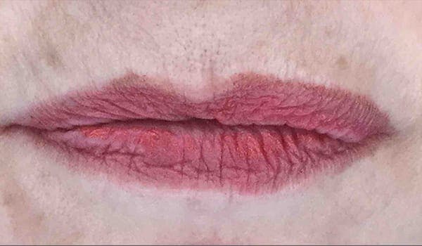 Fillers Before & After Gallery - Patient 239528 - Image 1