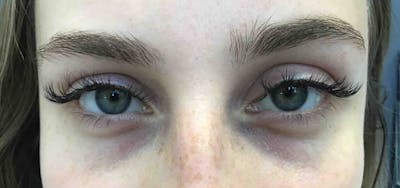Fillers Before & After Gallery - Patient 399841 - Image 1