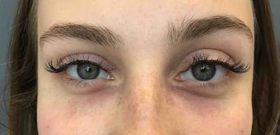 Fillers Before & After Gallery - Patient 399841 - Image 2
