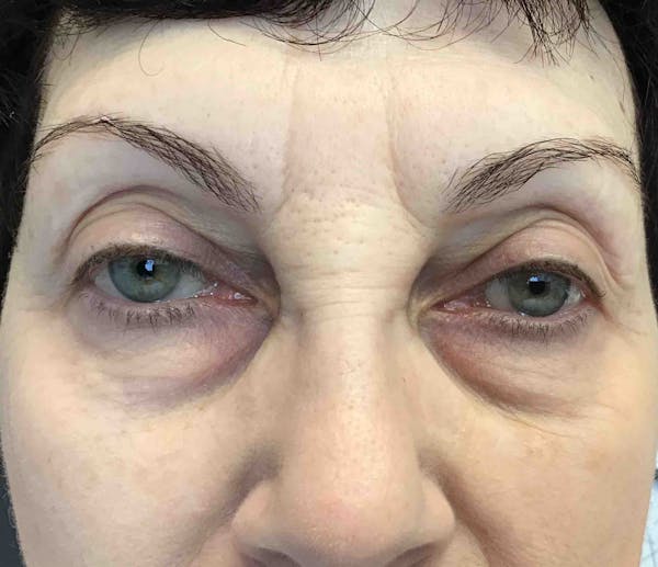 Fillers Before & After Gallery - Patient 234054 - Image 1