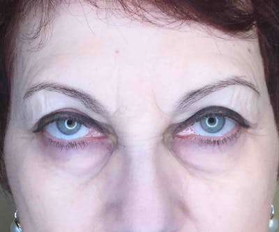 Fillers Before & After Gallery - Patient 234054 - Image 2