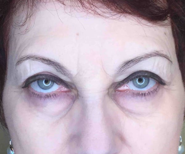 Fillers Before & After Gallery - Patient 234054 - Image 2