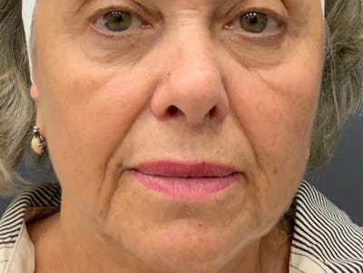 Fillers Before & After Gallery - Patient 152334 - Image 1